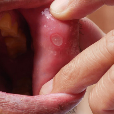 Έλκη στο στόμα: Πού μπορεί να οφείλονται (εικόνες)