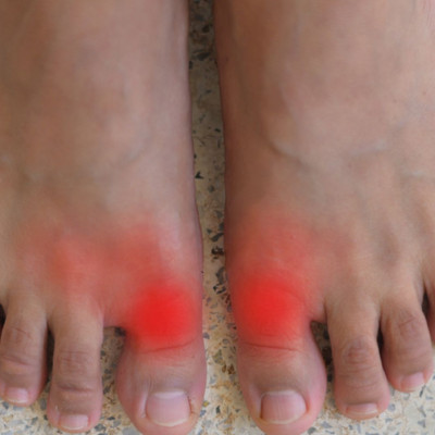 Ουρική αρθρίτιδα: Ποιοι κινδυνεύουν από τη φλεγμονώδη νόσο των αρθρώσεων (εικόνες)