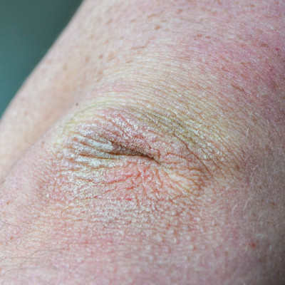 Ξηρότητα στους αγώνες και τα γόνατα: Τα οφέλη του αβοκάντο (video)