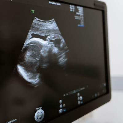 Αμνιοπαρακέντηση: Τι πρέπει να γνωρίζω για την εξέταση;