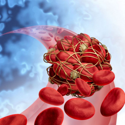 Θρόμβωση: Τα σημάδια που δεν πρέπει να αγνοείτε (video)