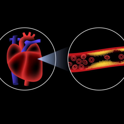 Πρόβλημα στις αρτηρίες: Προσοχή σε αυτά τα παράδοξα σημάδια (εικόνες)