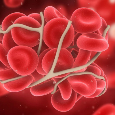 Θρόμβος: Ποια συμπτώματα προκαλεί ανάλογα με το σημείο που εντοπίζεται (εικόνες)