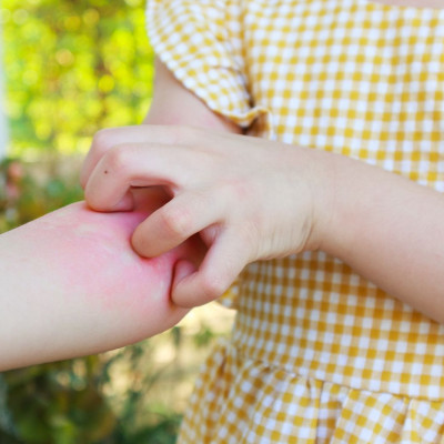 Δερματικά εξανθήματα σε παιδιά: Οι τύποι και τι να προσέξετε