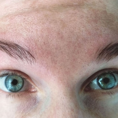 Μέλασμα ή πανάδες: Αντιμετώπιση με σπιτική μάσκα καρότου (video)