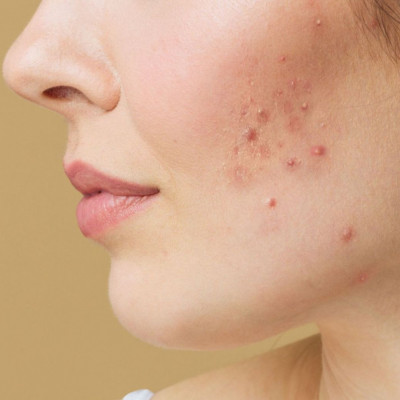 Ακμή: Ποιες κατηγορίες τροφών πρέπει να αποφεύγετε και γιατί (εικόνες)