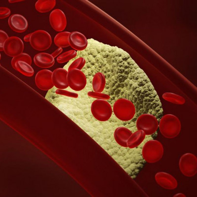 15 τροφές που καθαρίζουν τις αρτηρίες & μειώνουν τον κίνδυνο εμφράγματος (video)