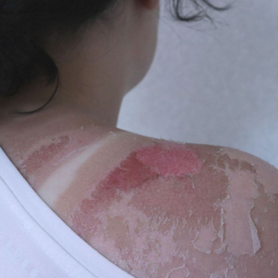 Πόσο διαρκεί ένα ηλιακό έγκαυμα; Υπάρχει τρόπος να το κάνετε να επουλωθεί γρηγορότερα;