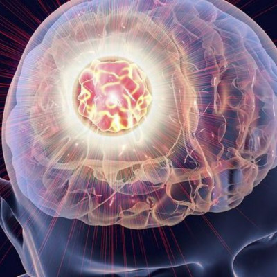 Όγκοι εγκεφάλου: Τα 7 πρώιμα σημάδια που πρέπει να προσέξετε