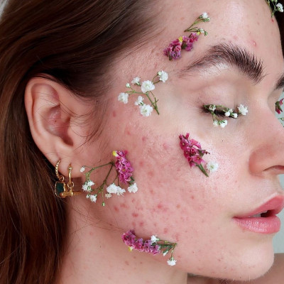 2 influencers που έχουν «αγκαλιάσει» την ακμή τους και πρέπει να ακολουθήσεις στο Instagram ASAP