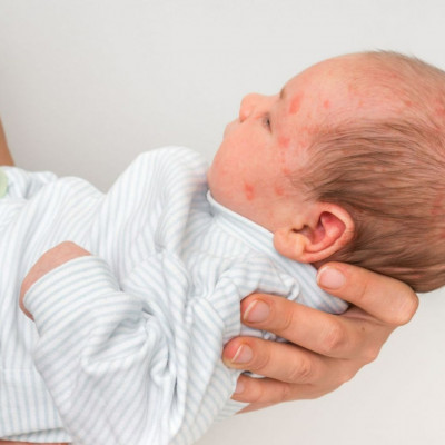 Βρεφική ροδάνθη: Η αιτία, η διάρκεια των συμπτωμάτων, οι επιπλοκές και η θεραπεία