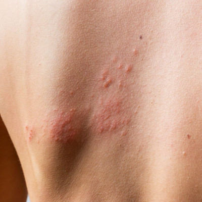 Ιός έρπητα ζωστήρα: Πώς συνδέεται με τον κίνδυνο εγκεφαλικού