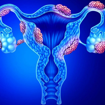 Ενδομητρίωση: Τα συμπτώματα μιας από τις κύριες αιτίες υπογονιμότητας