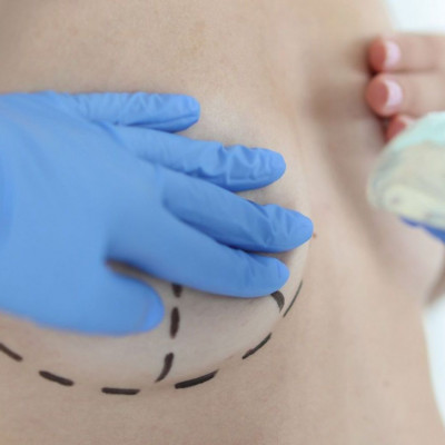 Aναπλαστικό μεγαλοκυτταρικό λέμφωμα: Ο ρόλος των εμφυτευμάτων στήθους