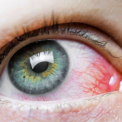 Επιπεφυκίτιδα: Τα είδη της και πώς θα την αντιμετωπίσετε