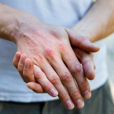 Ατοπική δερματίτιδα: Ποια η σχέση της με τις ημικρανίες