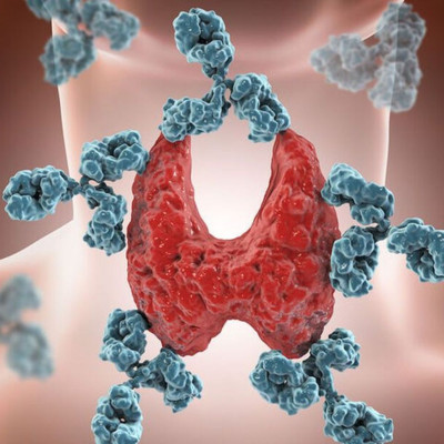 Καρκίνος θυρεοειδούς: Ο ρόλος της κεντρικής παχυσαρκίας