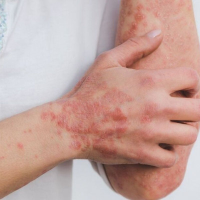 Ψωρίαση: Παράγοντες που πυροδοτούν τις εξάρσεις