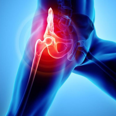 Οστεοαρθρίτιδα ισχίου: Οι βασικοί παράγοντες κινδύνου