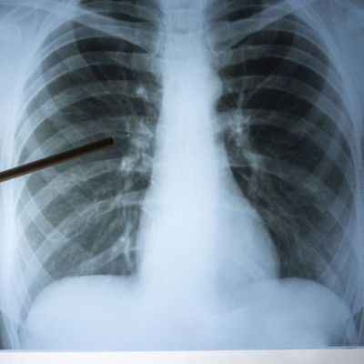 Τι είναι η κυστική ίνωση - Ποιοι οι διαθέσιμοι τρόποι αντιμετώπισης