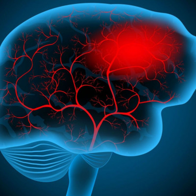 Εγκεφαλικό: Οι παράγοντες που αυξάνουν τον κίνδυνο