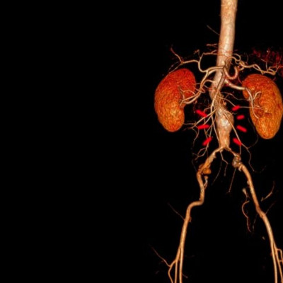 Ανεύρυσμα: Τα «αθόρυβα» συμπτώματα & πότε αντιμετωπίζεται οριστικά