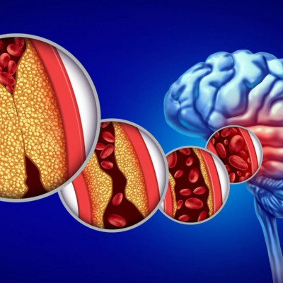 Χοληστερίνη: Γιατί δεν βλάπτει μόνο την καρδιά, αλλά και τον εγκέφαλο