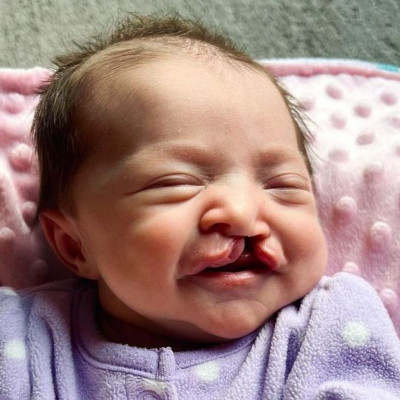 Το φώτο άλμπουμ της Millie που γεννήθηκε με λαγόχειλο