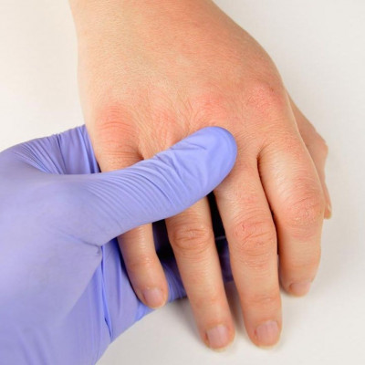 Ατοπική δερματίτιδα: Για ποιους καρκίνους αυξάνει τον κίνδυνο