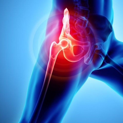 Οστεοαρθρίτιδα ισχίου: Οι βασικοί παράγοντες κινδύνου