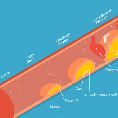 Φραγμένες αρτηρίες: Η διατροφή που μειώνει τον κίνδυνο καρδιαγγειακών