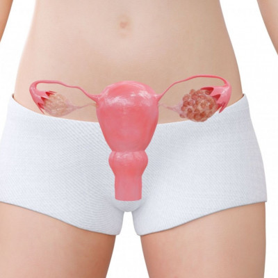 Σύνδρομο πολυκυστικών ωοθηκών & κίνδυνος πρόωρου θανάτου