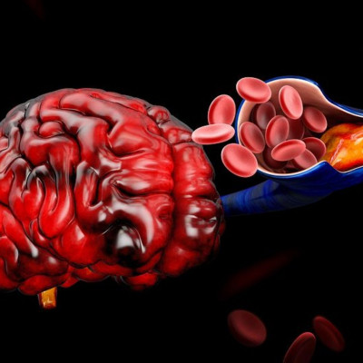 Θρόμβωση: Ποιοι άνθρωποι αντιμετωπίζουν πολλαπλάσιο κίνδυνο