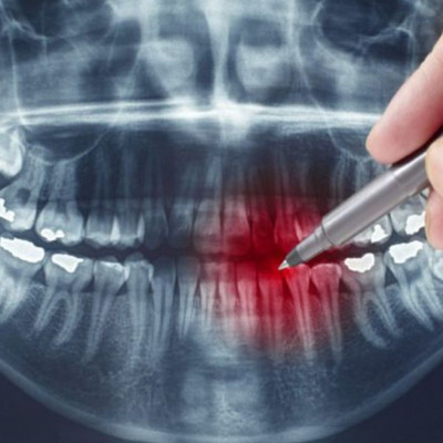 Τερηδόνα: Τι θα συμβεί αν αμελήσετε μία τρύπα στo δόντι