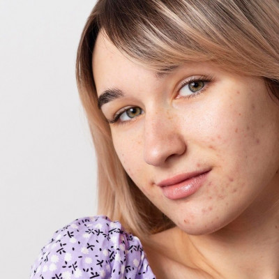 Ακμή στην προεφηβεία: Ποιο ρόλο παίζει το βάρος μας και πώς θα την αντιμετωπίσουμε αποτελεσματικά