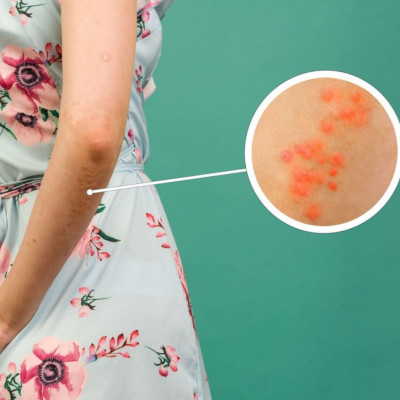 Ψωρίαση: Ποια άλλα όργανα μπορεί να επηρεάσει εκτός από το δέρμα