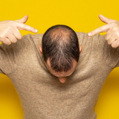 Γυροειδής αλωπεκία: Αιτίες, συμπτώματα και αντιμετώπιση