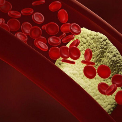 Καρδιαγγειακή νόσος: Πώς συνδέεται με τον κίνδυνο καρκίνου