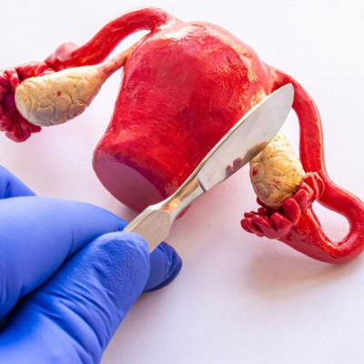 Προληπτική αφαίρεση ωοθηκών: Με ποια προβλήματα συνδέεται