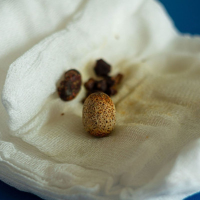 Ποιοι κινδυνεύουν να αναπτύξουν πέτρες στη χολή