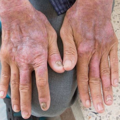 Σκληρόδερμα: Τα συμπτώματα και οι επιπτώσεις της αυτοάνοσης πάθησης