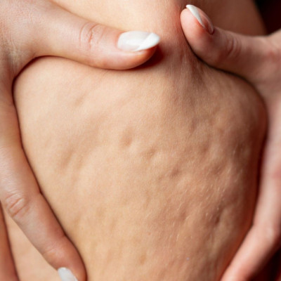 Καστορέλαιο για τη μείωση της κυτταρίτιδας