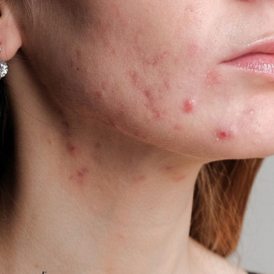 Period breakouts: Το δέρμα σου ξέρει ότι έρχεται περίοδος πριν από εσένα