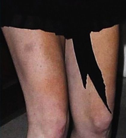 Με μελανιές και σε κακή κατάσταση μετά από έξοδο