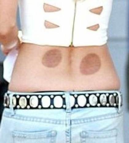 Ηθοποιός κυκλοφορεί δημόσια με σημάδια από… βεντούζες! (φωτό)