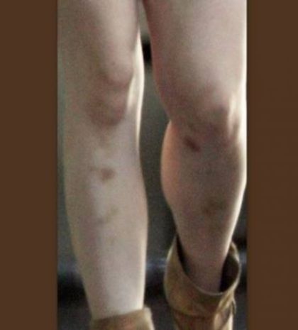 Κόρη διάσημου ηθοποιού με μώλωπες και χτυπήματα στα πόδια!