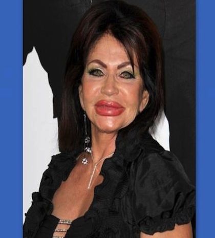 Απίστευτο! Παραμορφωμένη από τις πλαστικές η μαμά του….