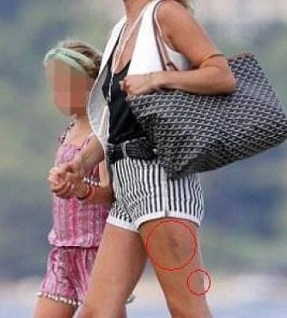 Πασίγνωστο μοντέλο εμφανίστηκε με μελανιές στα πόδια!