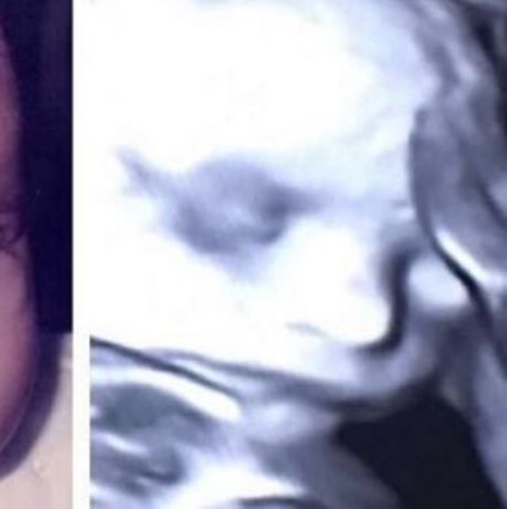 Από τον υπέρηχο… μοιάζει στη μαμά του! (εικόνα)