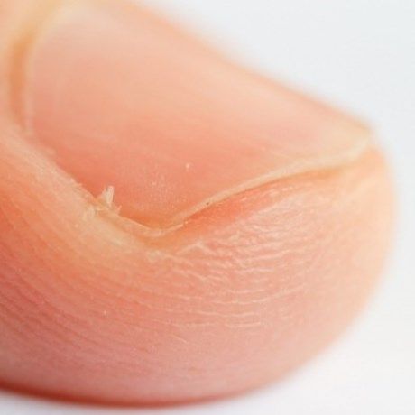 Πως να απαλλαγείτε από τις παρωνυχίδες στα χέρια